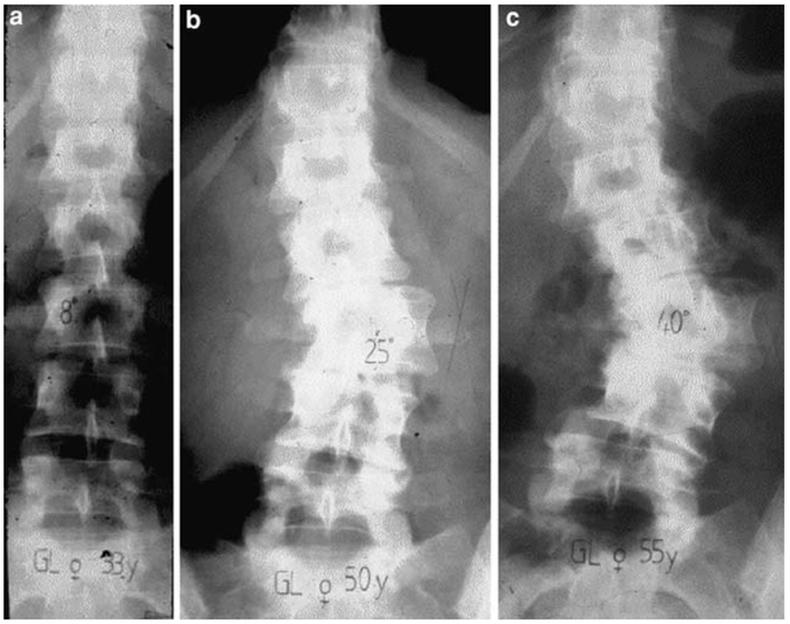 Идиопатический сколиоз 2 степени. Ступенеобразная деформация позвонка. Диффузионное искривление позвоночника. Генетические заболевания с деформацией позвоночника. Спондилометрия Кобба.